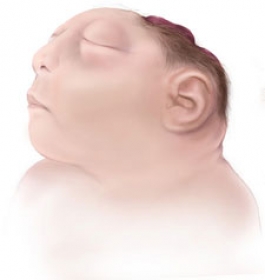 infant with birth defects such as anencephaly could not be aborted under the bill